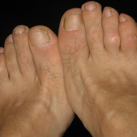 corns and calluses