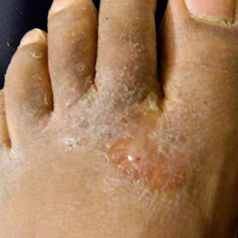fungal infections