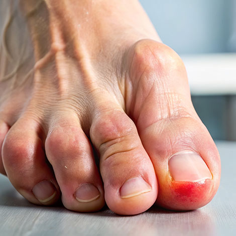 hammer toes
