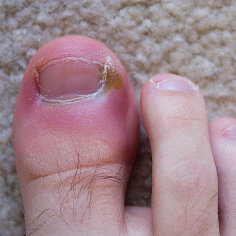 toenail treatments